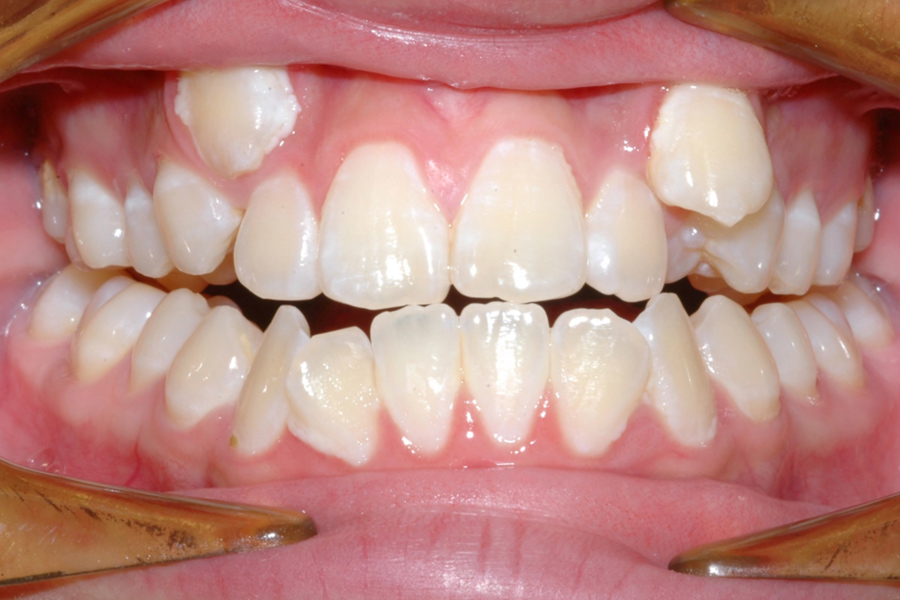 Orthodontics before after photo