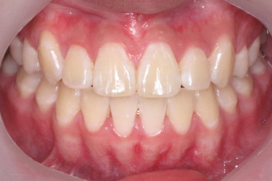 Orthodontics before after photo