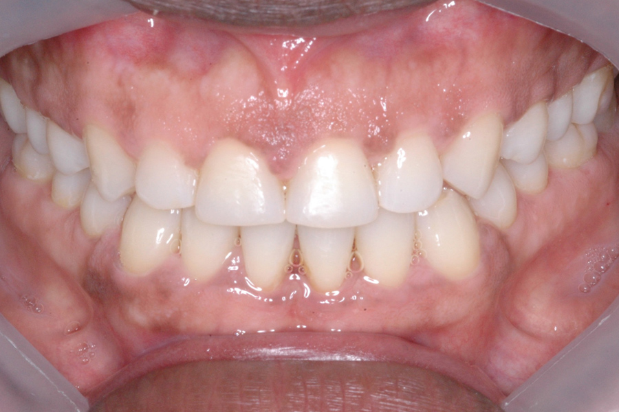 Orthodontics before after photo