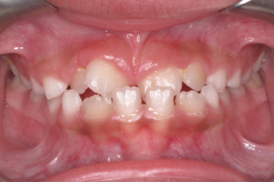 Orthodontics before after photo