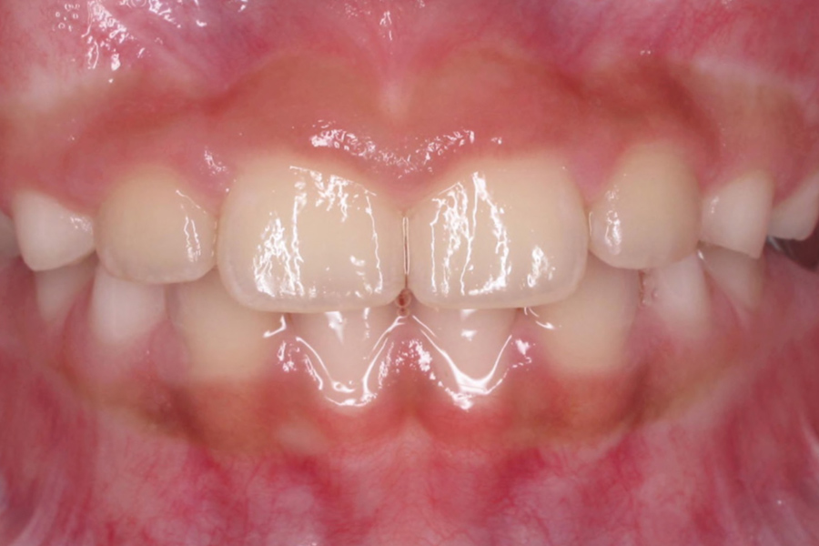 Orthodontics before after photo