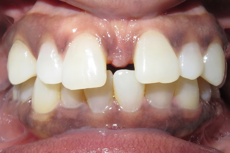 Orthodontics before after photo