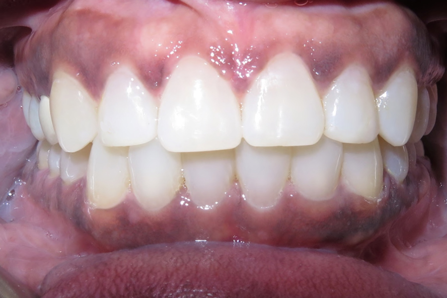 Orthodontics before after photo